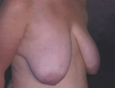 Patient # 43058 Before Photo # 1